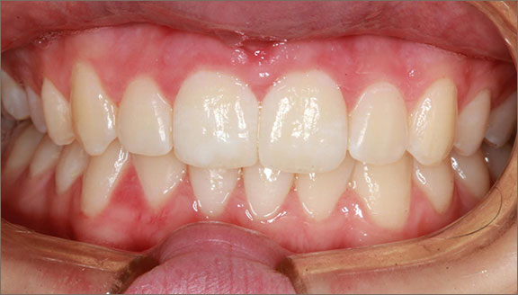 invisalign 4 after