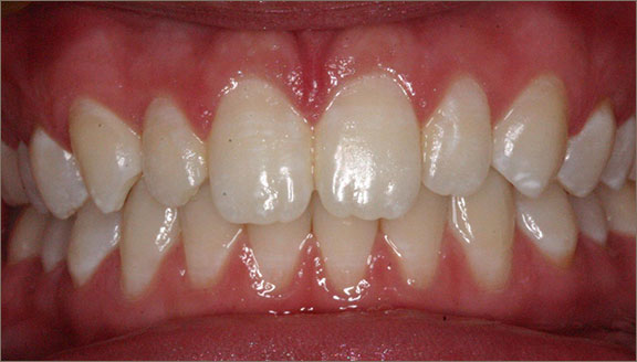 invisalign 5 after