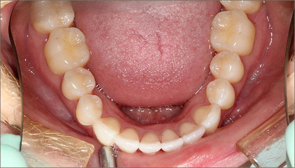 invisalign 6 after
