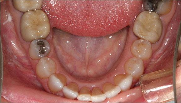 invisalign 7 after