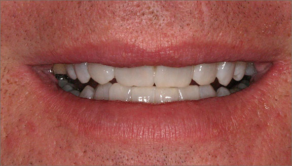 whitening 1 after