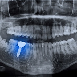 X-ray showing dental implant in Reynoldsburg, OH integrated with jawbone
