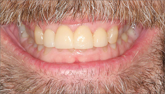 anterior 8 after