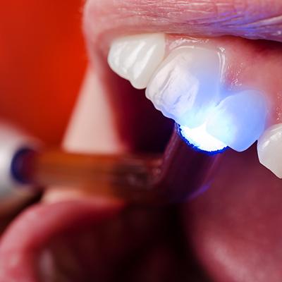 direct bonding light behind tooth
