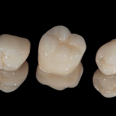 Close-up of three dental crowns in Reynoldsburg, OH