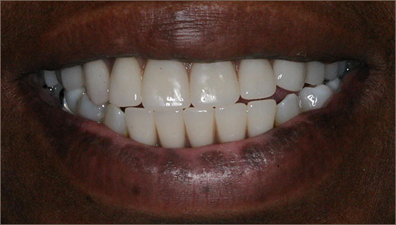 Dentures patient 1 after
