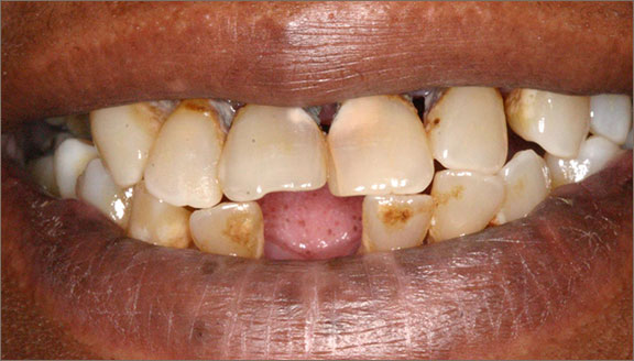 Dentures patient 1 before