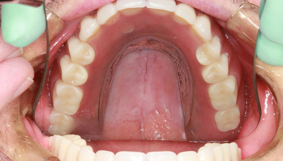 Dentures patient 2 afetr