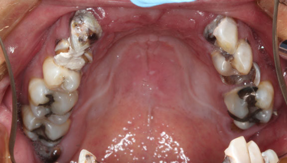 Dentures patient 2 before