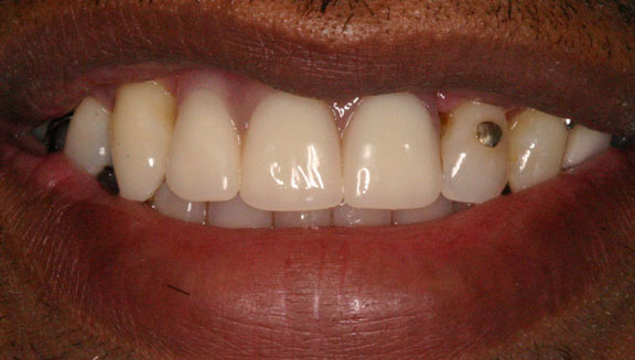 Dentures patient 3 after