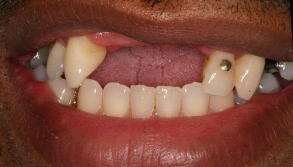 Dentures patient 3 before