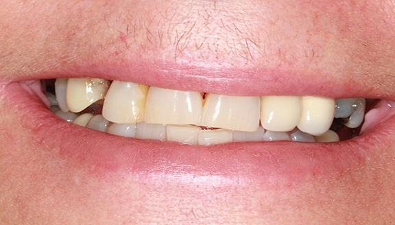 Dentures patient 4 before