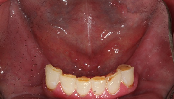dentures patient 6 before
