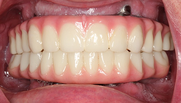 dentures patient 7 after