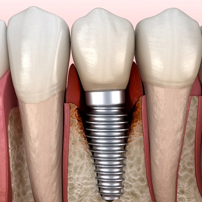 Peri-implantitis, a common cause of dental implant failure