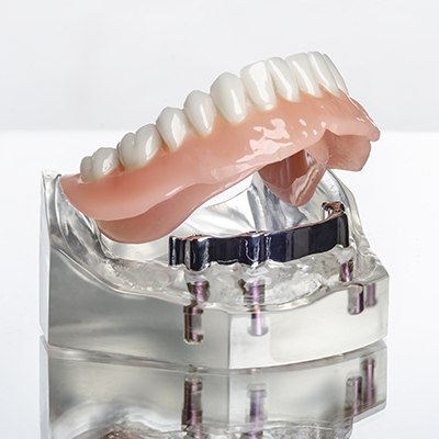 implant retained denture mockup