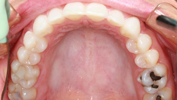 invisalign 1 after