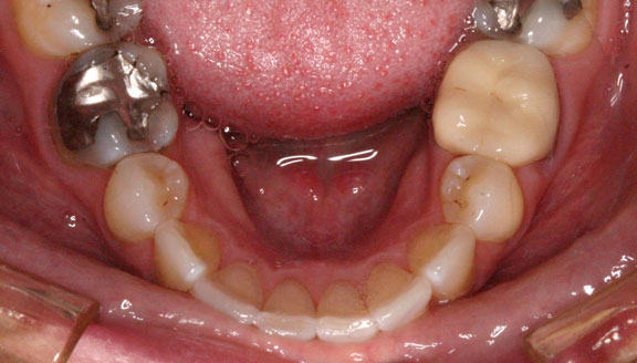 invisalign 2 after
