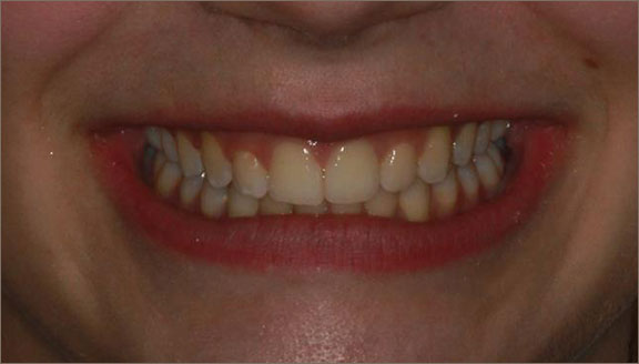 invisalign 8 after