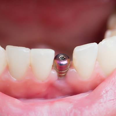mini implant in gums