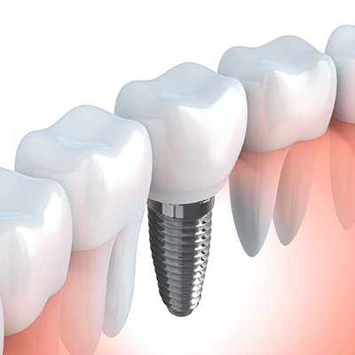 implant between teeth