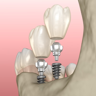mini implants illustration