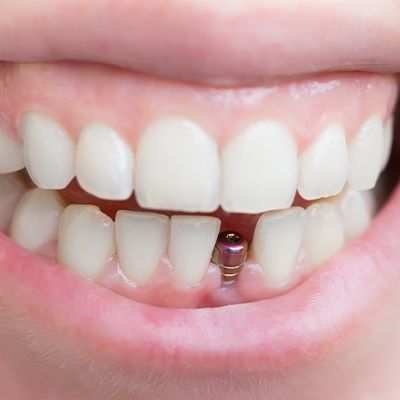 metal dental implant in smile